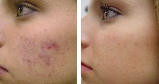 Antes e despois da crioterapia